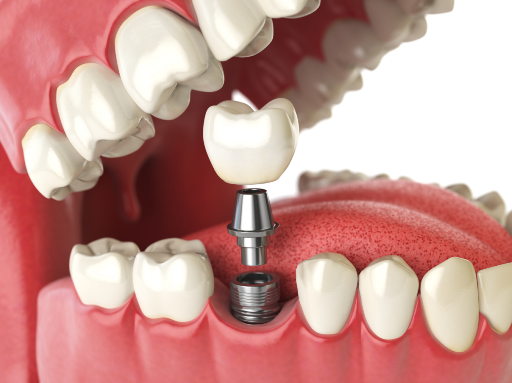 dental implants picture Bruggeman dental dentist in thornton colorado Dr. Scott Bruggeman. Bruggeman Dental. General, Cosmetic, Restorative, Family Dentistry Dentist in Thornton, CO 80023