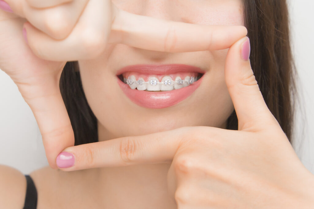 braces person with braces Bruggeman dental dentist in thornton colorado Dr. Scott Bruggeman