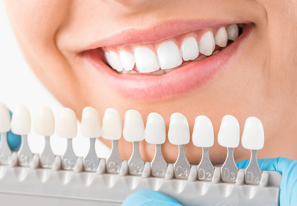 Dental Bonding Benefits for Tooth Repair - Perkins Dental Care