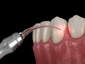 laser dentistry lasering gum illustration Bruggeman dental dentist in thornton colorado Dr. Scott Bruggeman 
