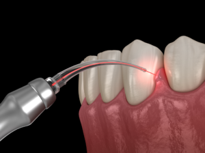 Gum Disease Periodontal Disease lasering gum illustration Bruggeman dental dentist in thornton colorado Dr. Scott Bruggeman