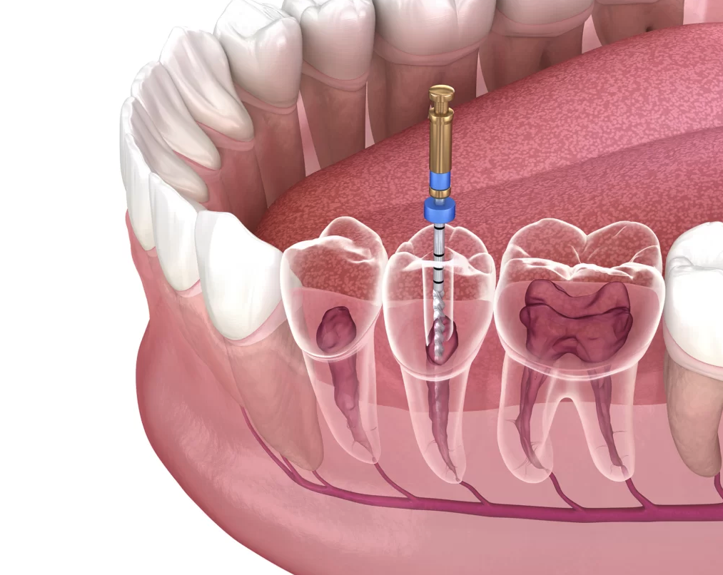 Root Canal Treatment Bruggeman dental dentist in thornton colorado Dr. Scott Bruggeman