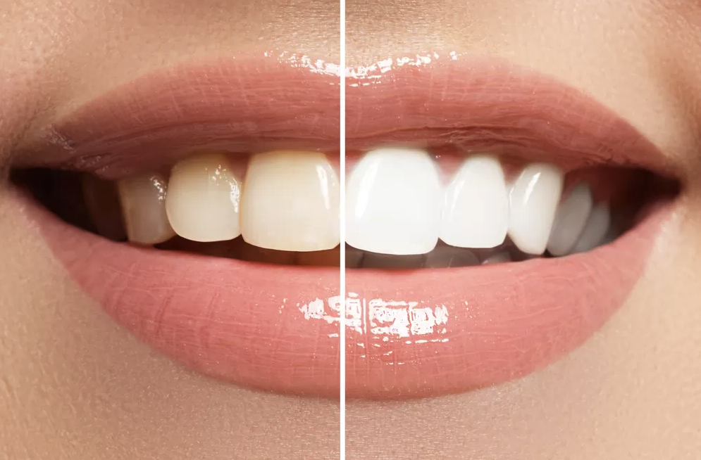 Teeth Whitening in Thornton, CO Bruggeman dental dentist in thornton colorado Dr. Scott Bruggeman