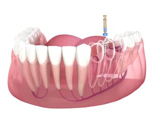 root canals thornton Dr. Scott Bruggeman. Bruggeman Dental. General, Cosmetic, Restorative, Family Dentistry  Dentist in Thornton, CO 80023